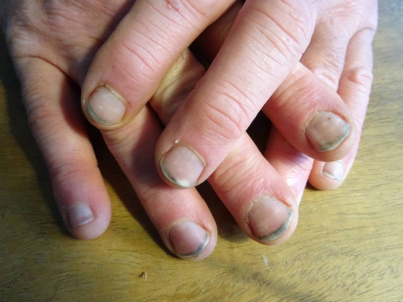 Zwarte nagels….
